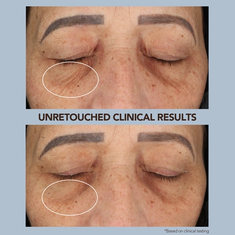 BEAR 2 Clinical Results eyes