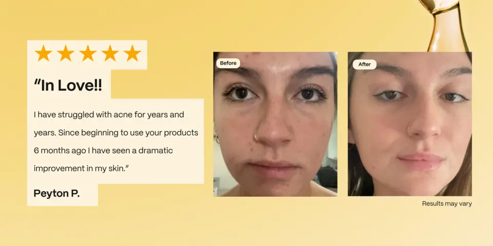 I have struggled with acne for years and years. Since beginning to use your products 6 months ago I have seen a dramatic improvement in my skin.