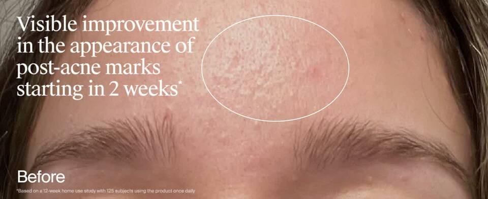 thumbnail video image 2 of Neutrogena Evenly Clear Retinoid, Adapalene Gel 0.1%, 0.5 oz, 2 of 13