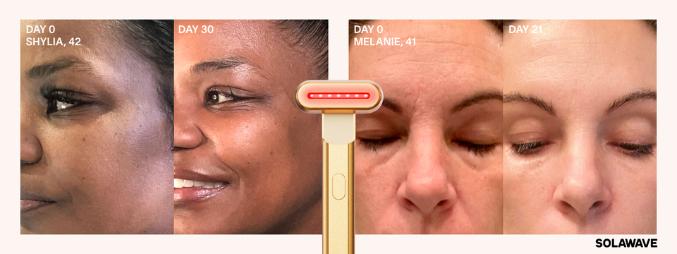 Before and after results after 30 days using Solawave Gold 4-in-1 Wand