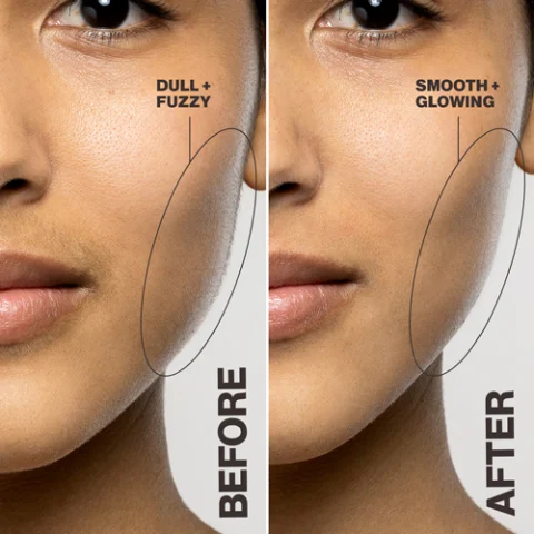 Before and after image showing change in cheek line