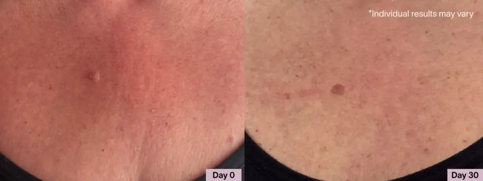 Before and after results of light therapy for neck and chest showing smoother-looking skin after 30 days
