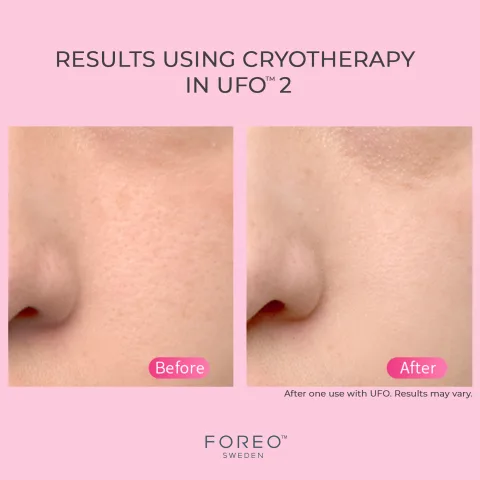 Cryotherapy Before And After