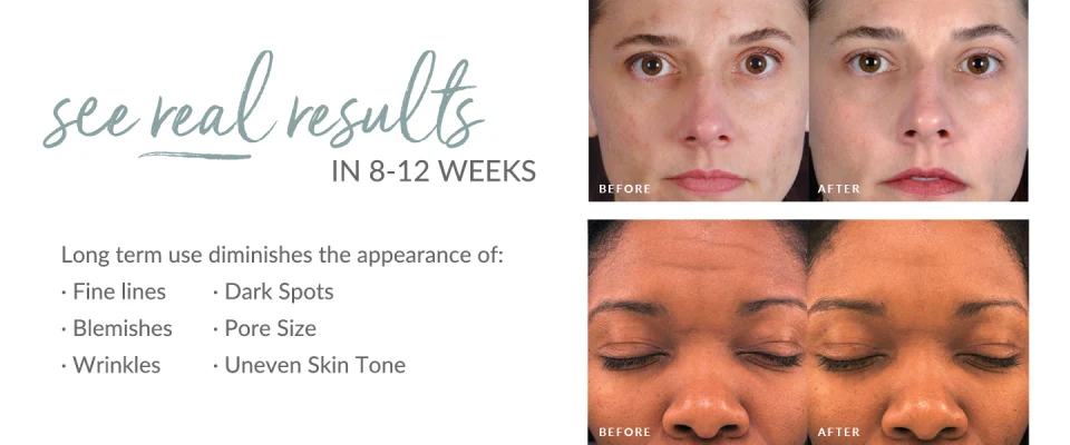 See real results in 8-12 weeks. Benefits include diminishing the appearance of fine lines, blemishes, wrinkles, dark spots, pore size, and uneven skin tone. Two before and afters shown that reflect the benefits.