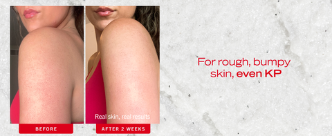 Skin before and after using KP Body Bump Scrub Eraser, showing brighter, smoother skin