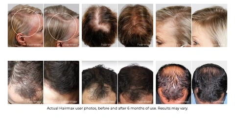 Hairmax before &amp; after photos