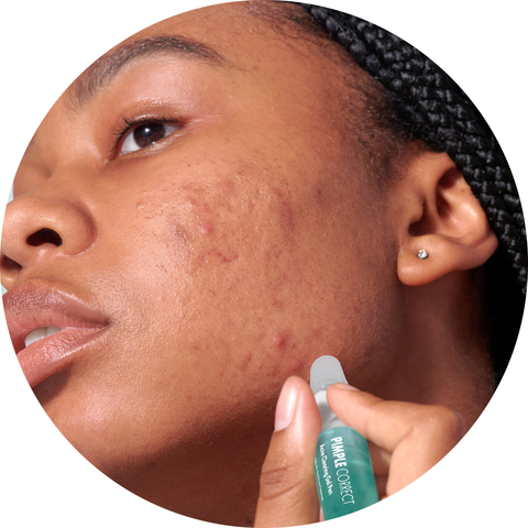 Handles hard-to-reach pimples