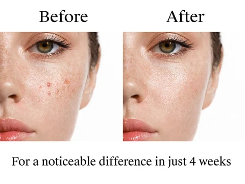 Neutrogena Rapid Clear Stubborn Acne Medication Spot Treatment Gel