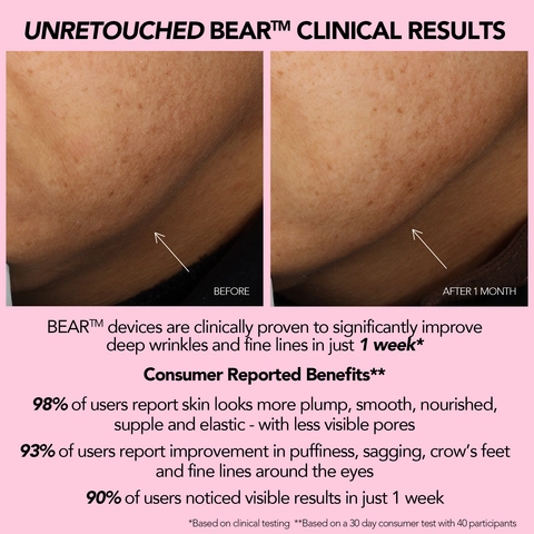 Participants saw more firmness around the jawline after 30 days.