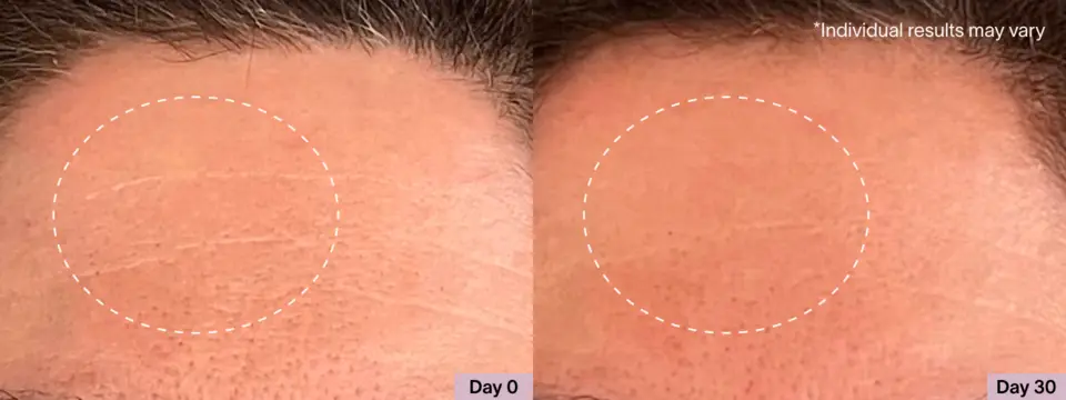 Before and after using face light therapy mask showing smoother-looking skin after consistent use