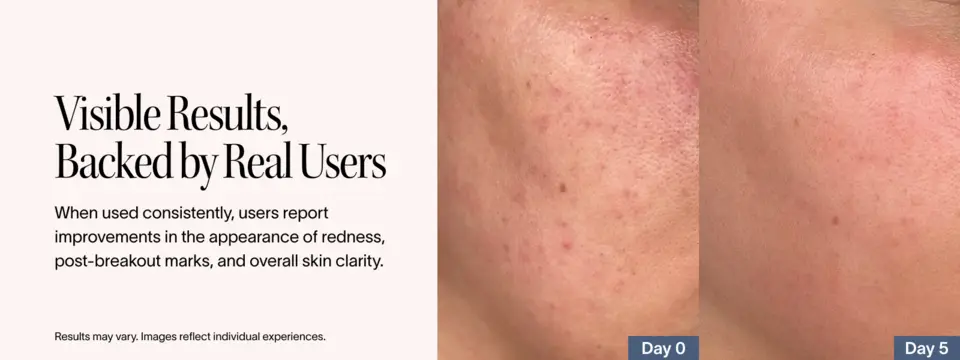 Before and after images showing improved appearance of redness over time.