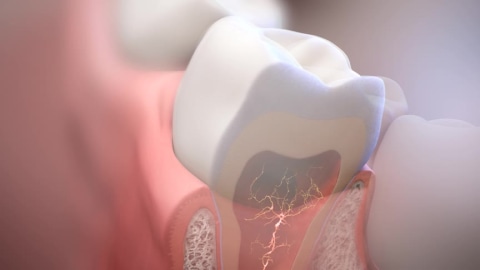 thumbnail video image 2 of Listerine 24-HR Tooth Sensitivity Relief & Protection Alcohol-Free Formula Sensitivity Mouthwash, Fresh Mint Fl (Pack of 6), 2 of 12