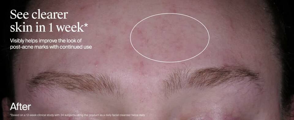 thumbnail video image 2 of Neutrogena Evenly Clear Acne Cleanser with Salicylic Acid, 9.1 fl. oz, 2 of 13