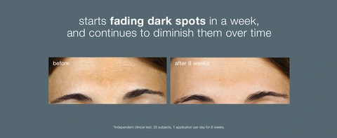 Clinical before and after showing visible reduction of forehead dark spots over 8 weeks.