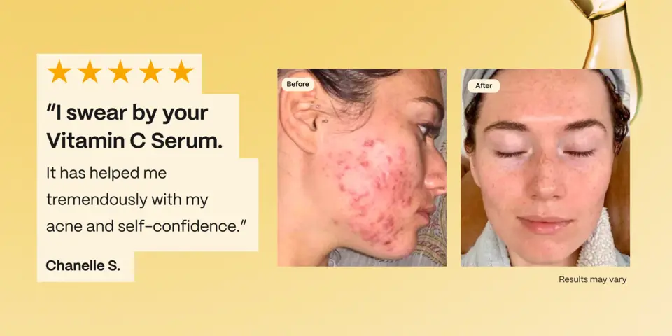 It has helped me tremendously with my acne and self-confidence.