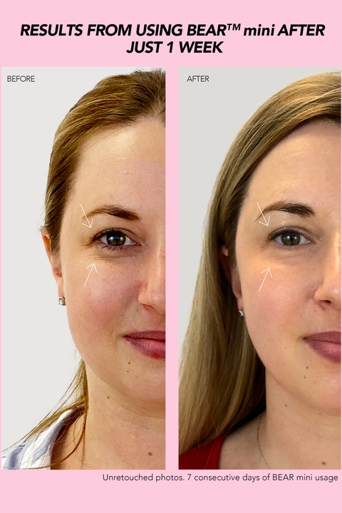 split face before and after showing the results from using BEAR mini after 1 week