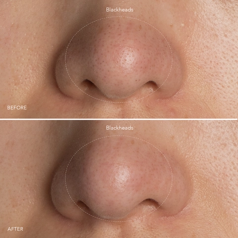 Before and After image of nose using KIWI device