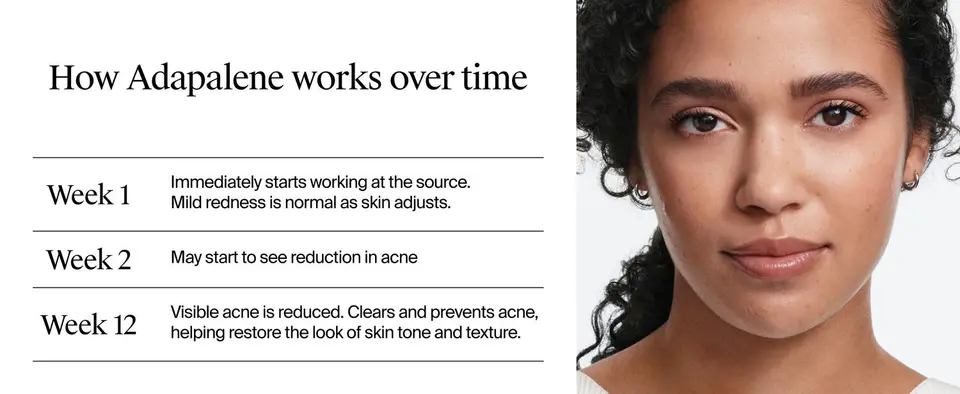 retinoids for face, retinoid serum, gentle retinoid, acne retinol acne gel anti acne acne prone skin