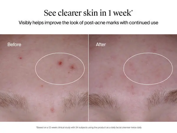 salicylic acid face wash oil free acne prone skin cleanser for acne prone skin acne treatment