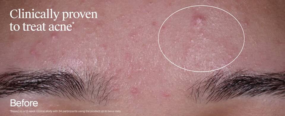 thumbnail video image 2 of Neutrogena Evenly Clear Acne Exfoliant, Salicylic Acid, 1 fl. oz, 2 of 14