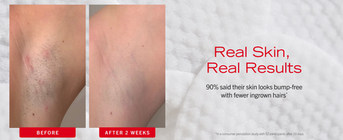 Armpit before and after 2 weeks of using ingrown hair pads, showing less redness and irritation