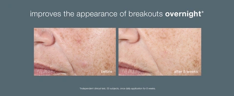 Before and after skincare results showing reduced breakouts after 8 weeks of treatment