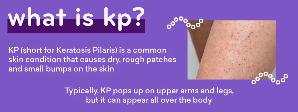 What is KP?